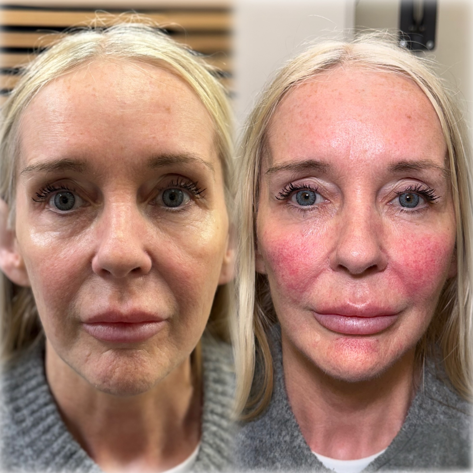 Injectables result at NAS Beauty by Nadya, Northampton