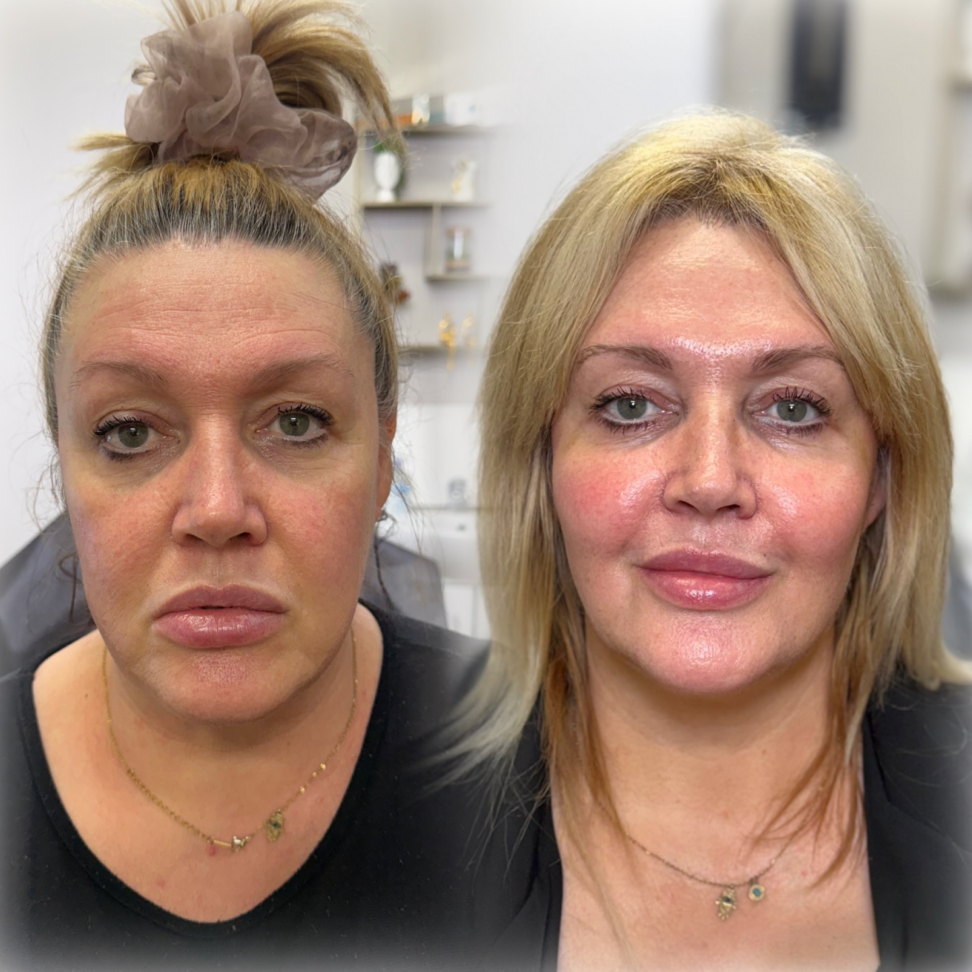 Injectables result at NAS Beauty by Nadya, Northampton
