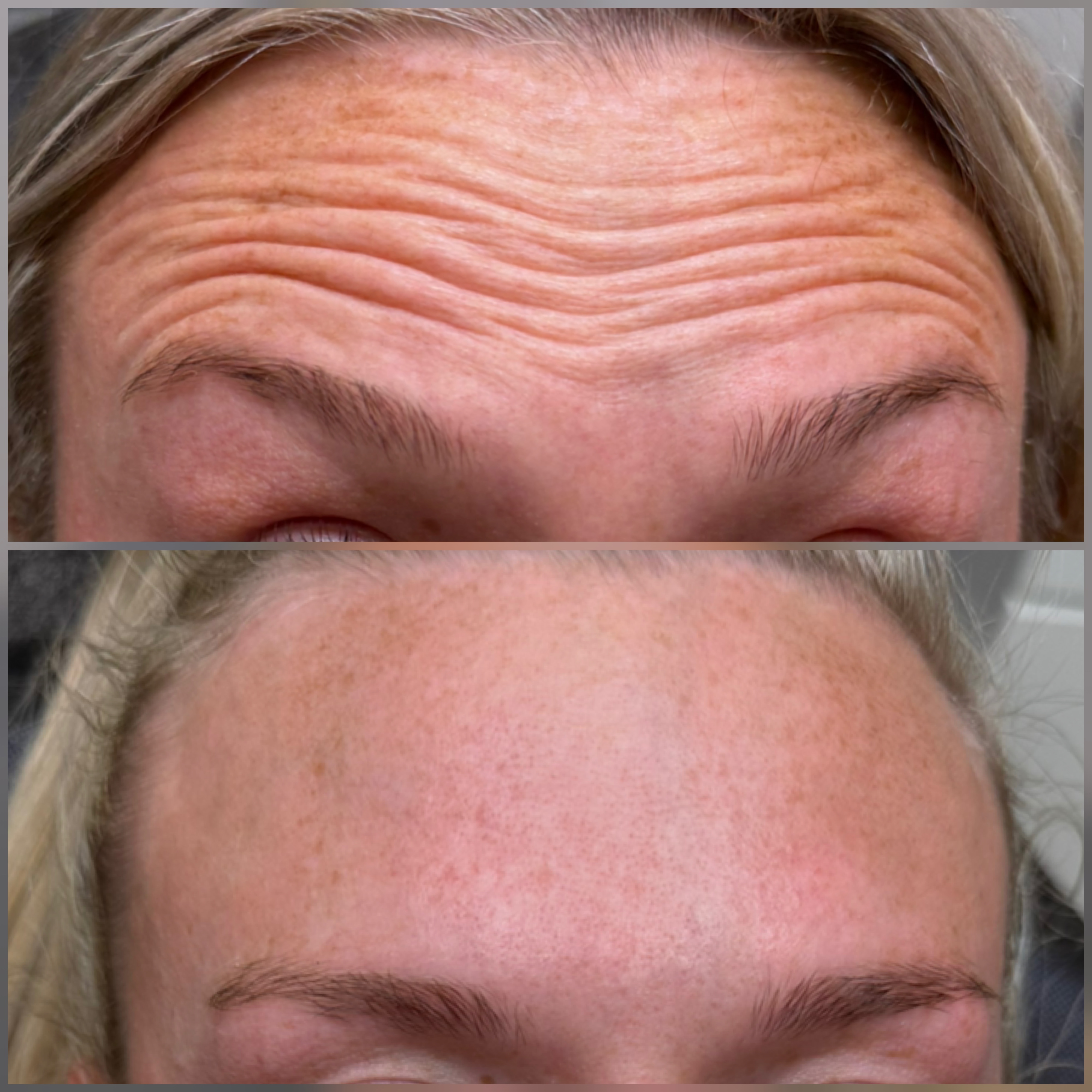 Anti-Wrinkle Injections result at NAS Beauty by Nadya in Northampton