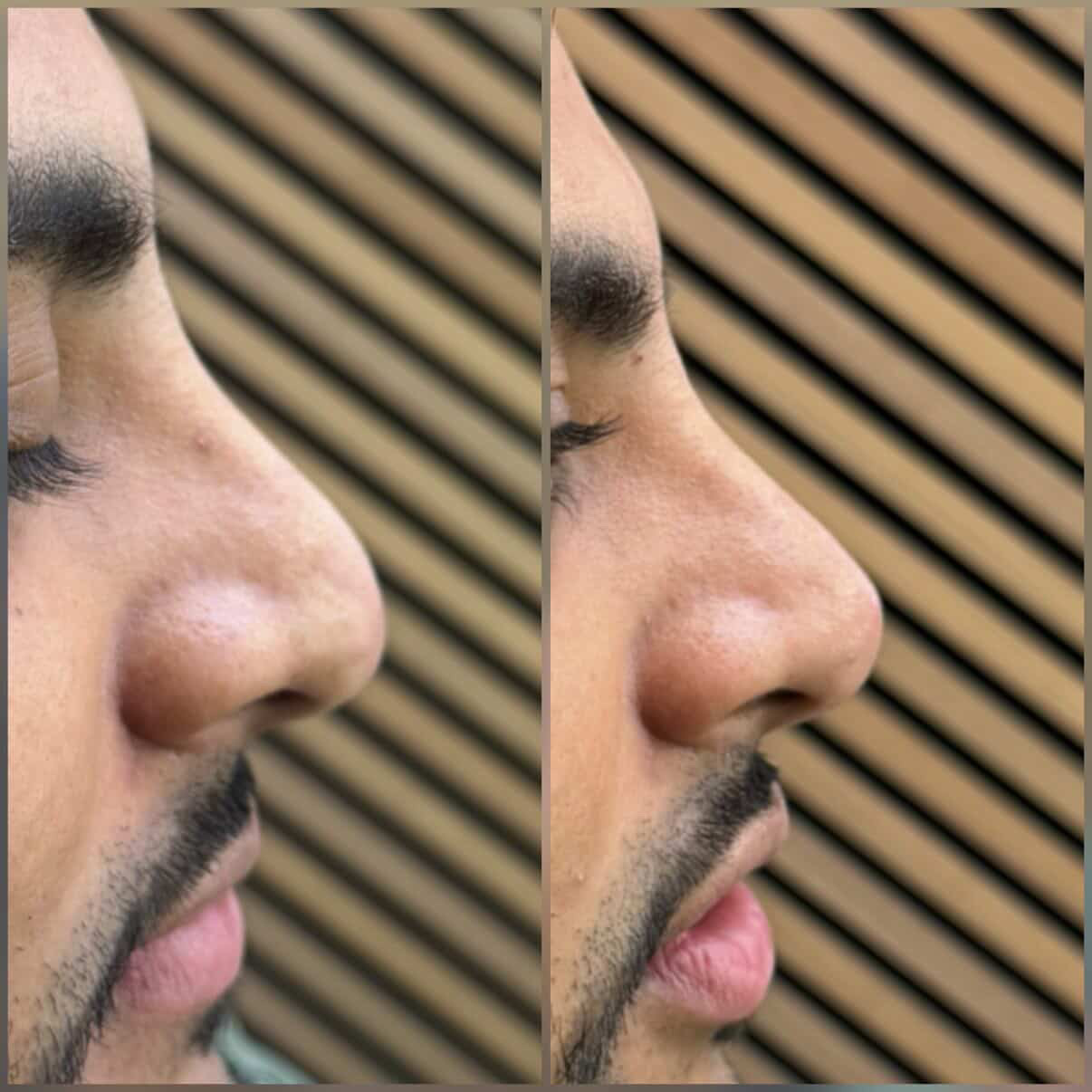 Injectables result at NAS Beauty by Nadya, Northampton