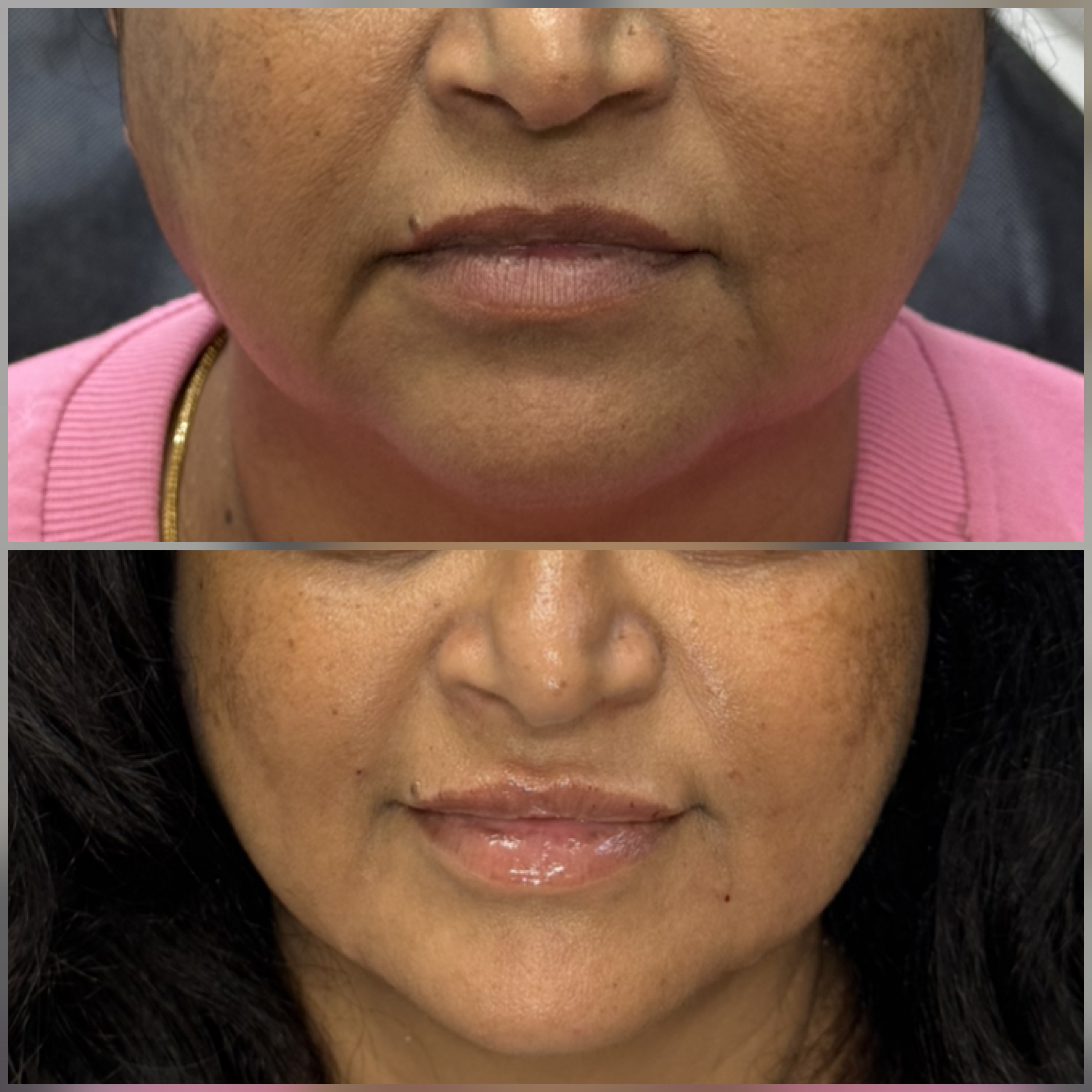 Injectables result at NAS Beauty by Nadya, Northampton