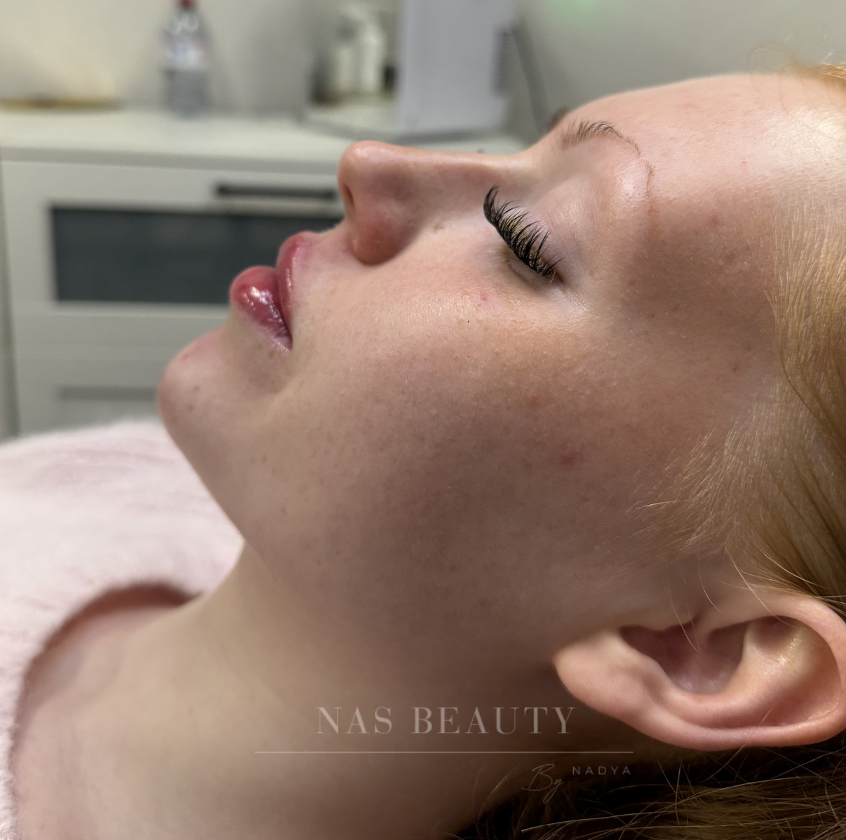 Injectables result at NAS Beauty by Nadya, Northampton