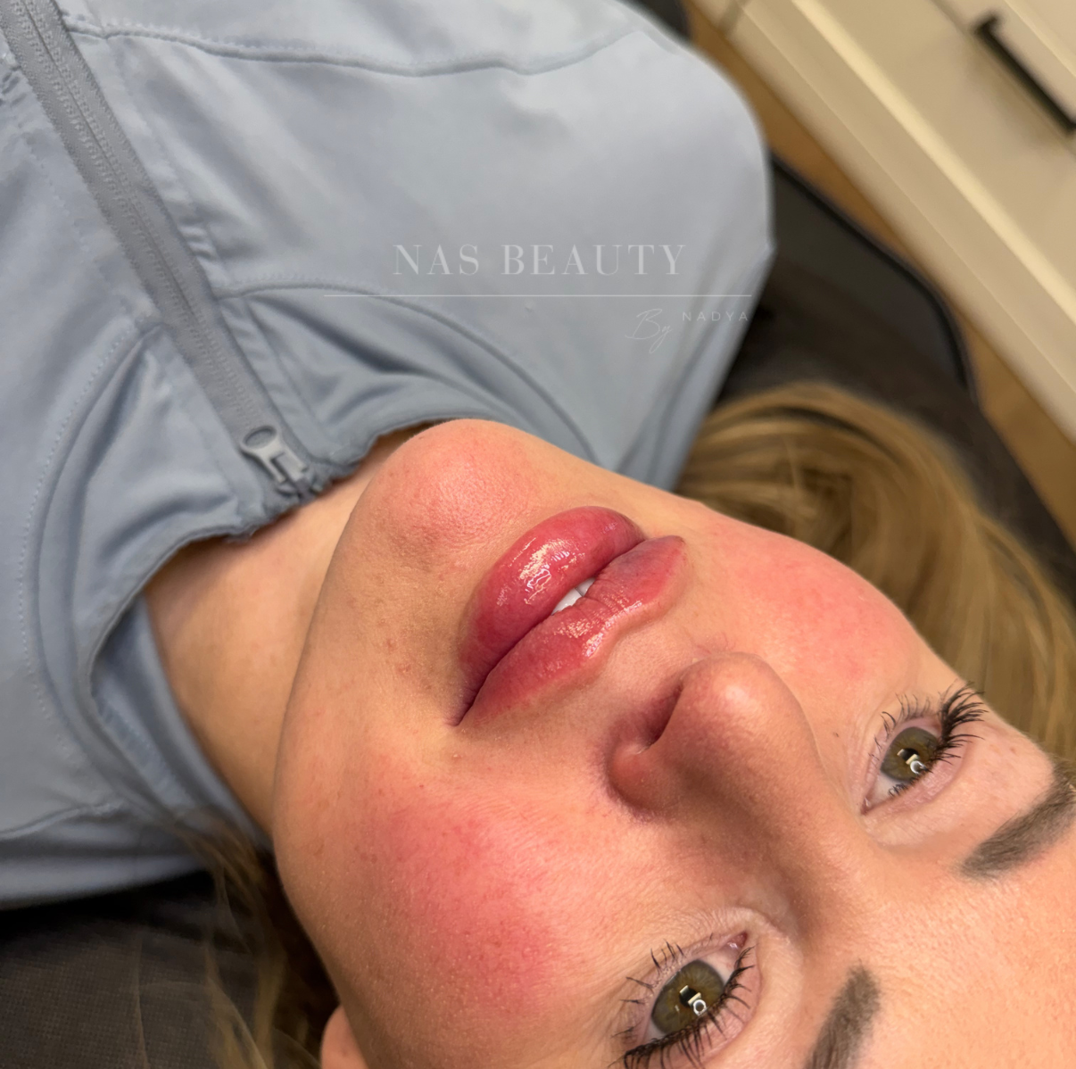 Injectables result at NAS Beauty by Nadya, Northampton
