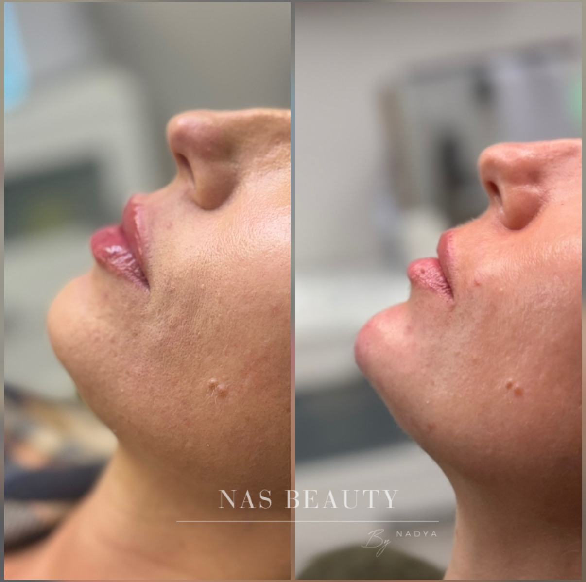 Injectables result at NAS Beauty by Nadya, Northampton
