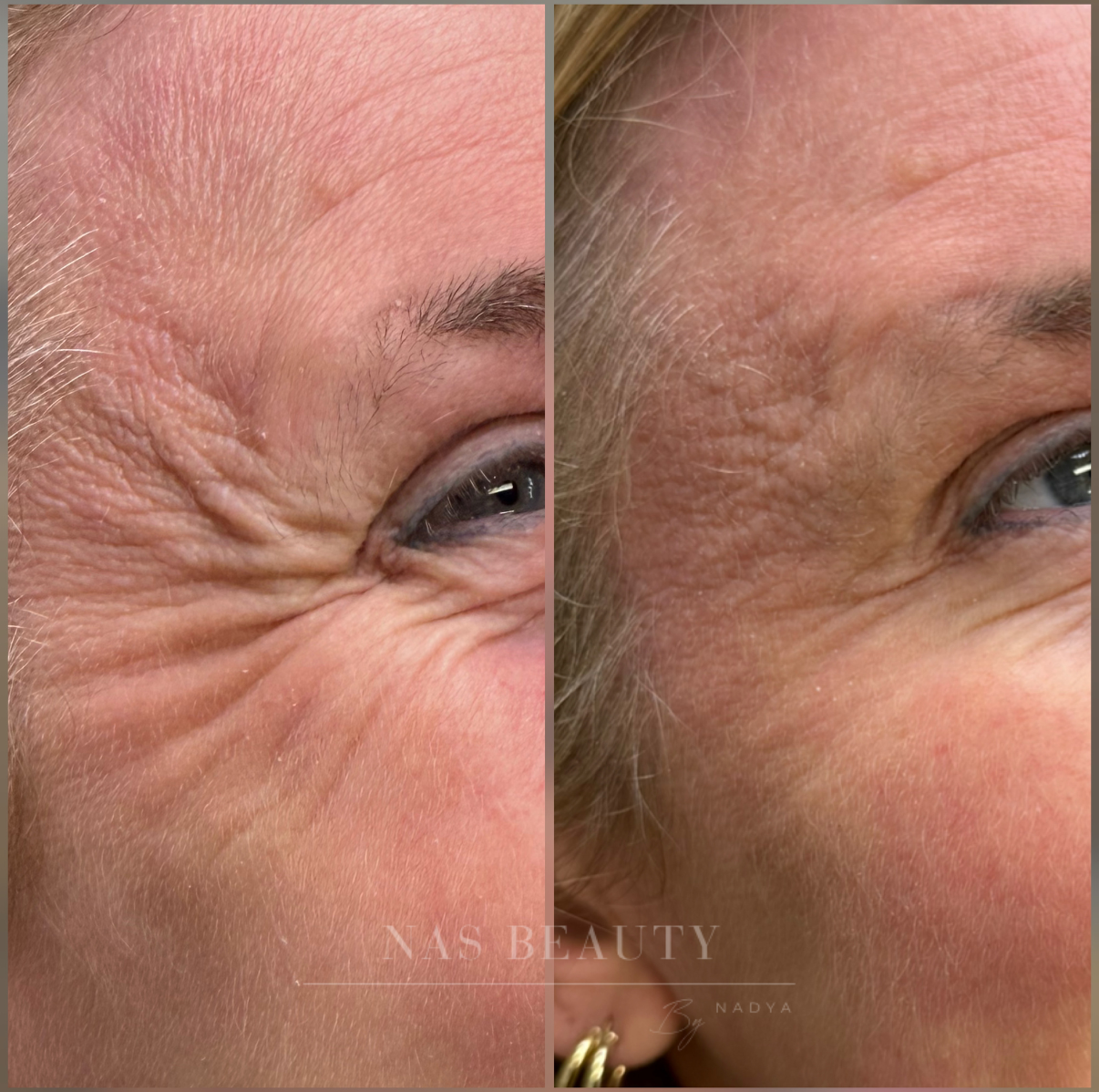 Anti-Wrinkle Injections result at NAS Beauty by Nadya in Northampton