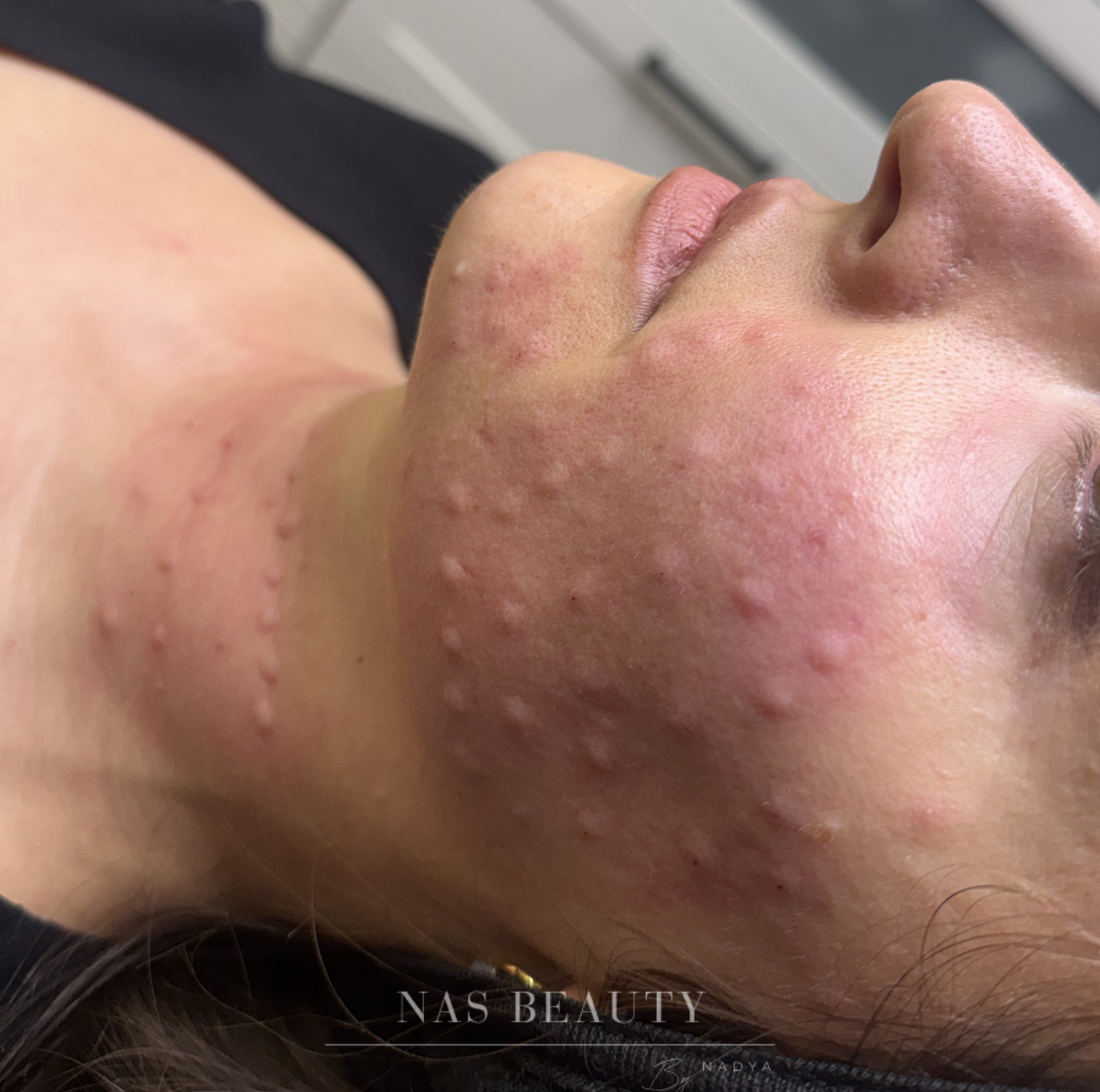 Skin Boosters & Polynucleotides result at NAS Beauty by Nadya in Northampton