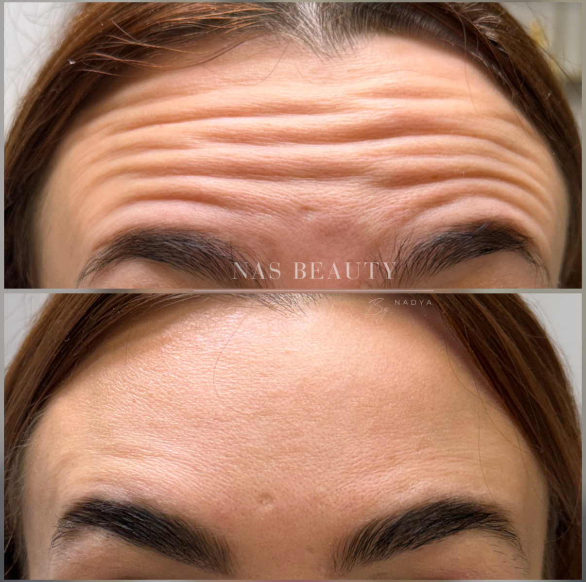 Anti-Wrinkle Injections result at NAS Beauty by Nadya in Northampton